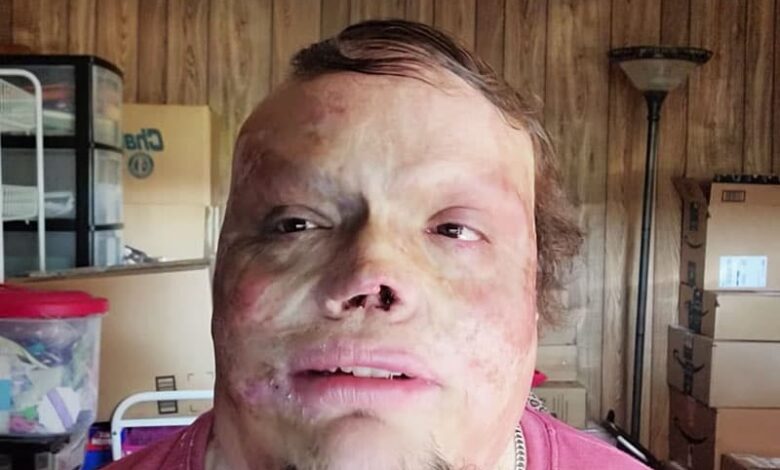 Man Who Overcame Pain And Discrimination To Tell His Miracle Story